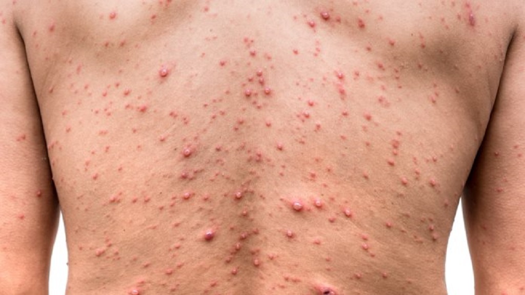 ¿Cómo se propaga la viruela del mono?